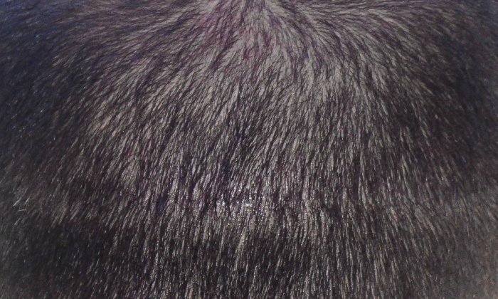 Micro haar pigmentatie litteken hoofd
