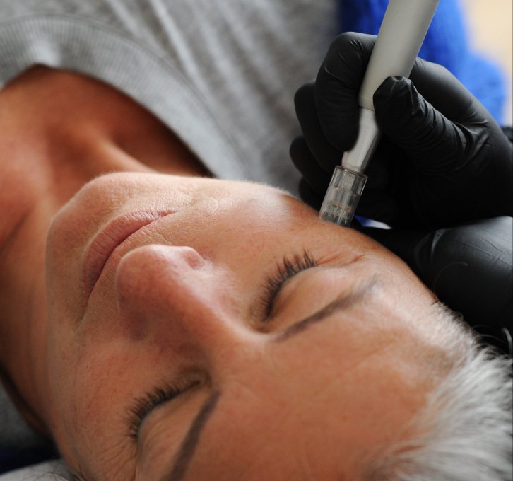 Cursus microneedling