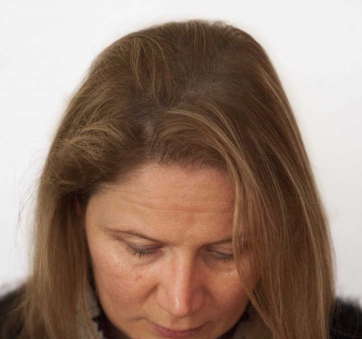 Micro haar pigmentatie vollere coupe met tricoroller