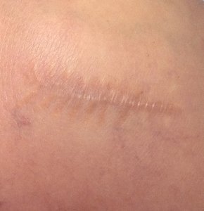 Medische tatoeage litteken camoufleren