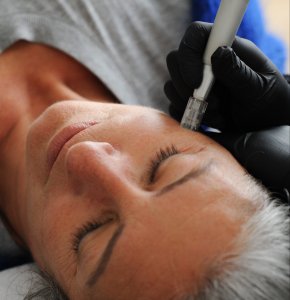 Opleiding microneedling huidverbetering