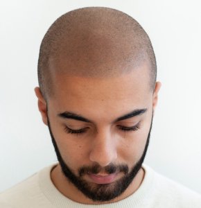 Tricopigmentatie opleiding kortgeschoren look stoppeltattoo